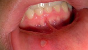 Canker sore prevention tips