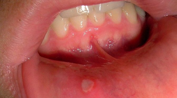 Canker sore prevention tips