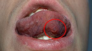 Mucocele remedies