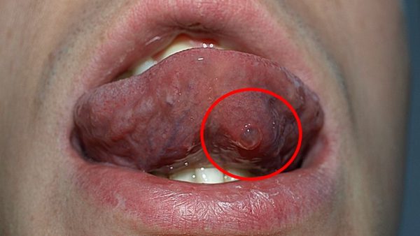 Mucocele remedies