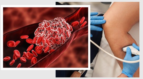 Blood clot relief