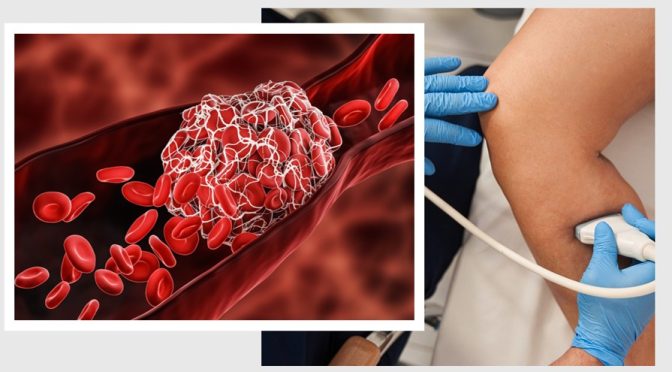 Blood clot relief