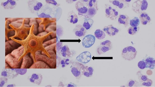 Brain eating amoeba