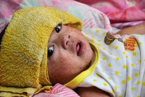 Measles in children